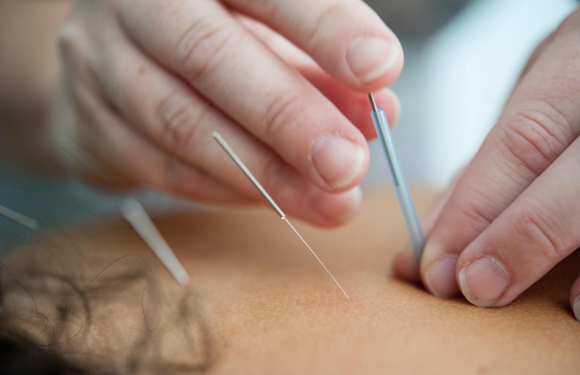 L'acupuncture pendant les règles